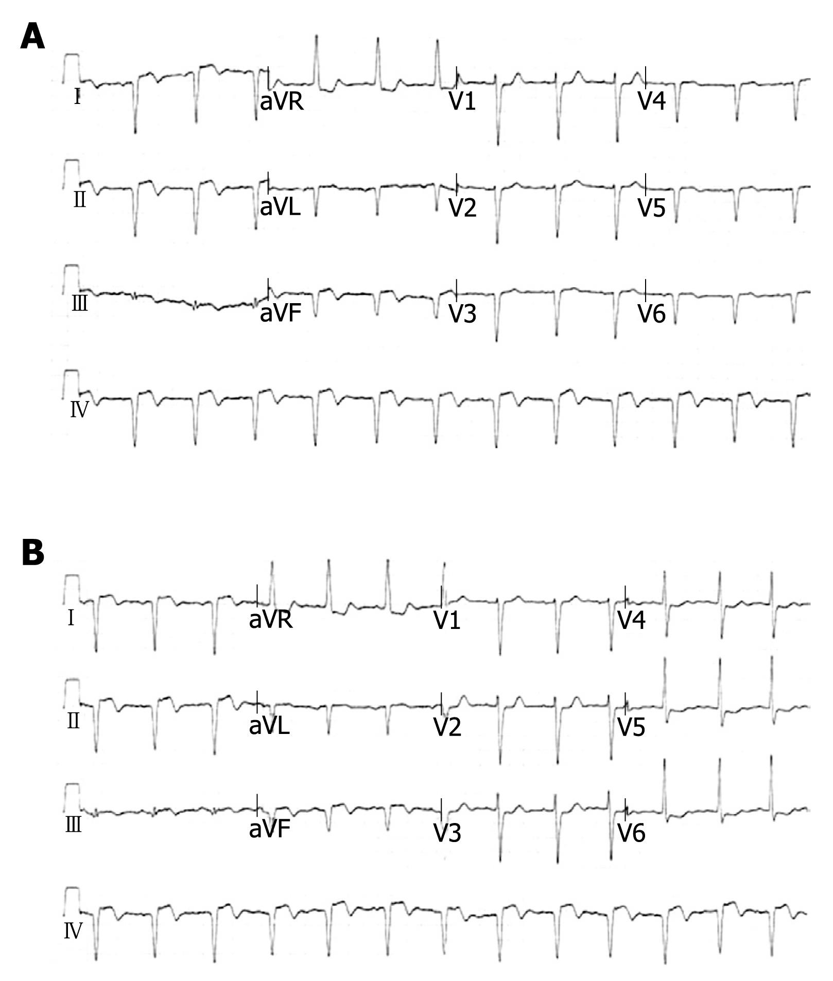 Percutaneous Coronary Intervention For Acute Myocardial Infarction In A Patient With Dextrocardia