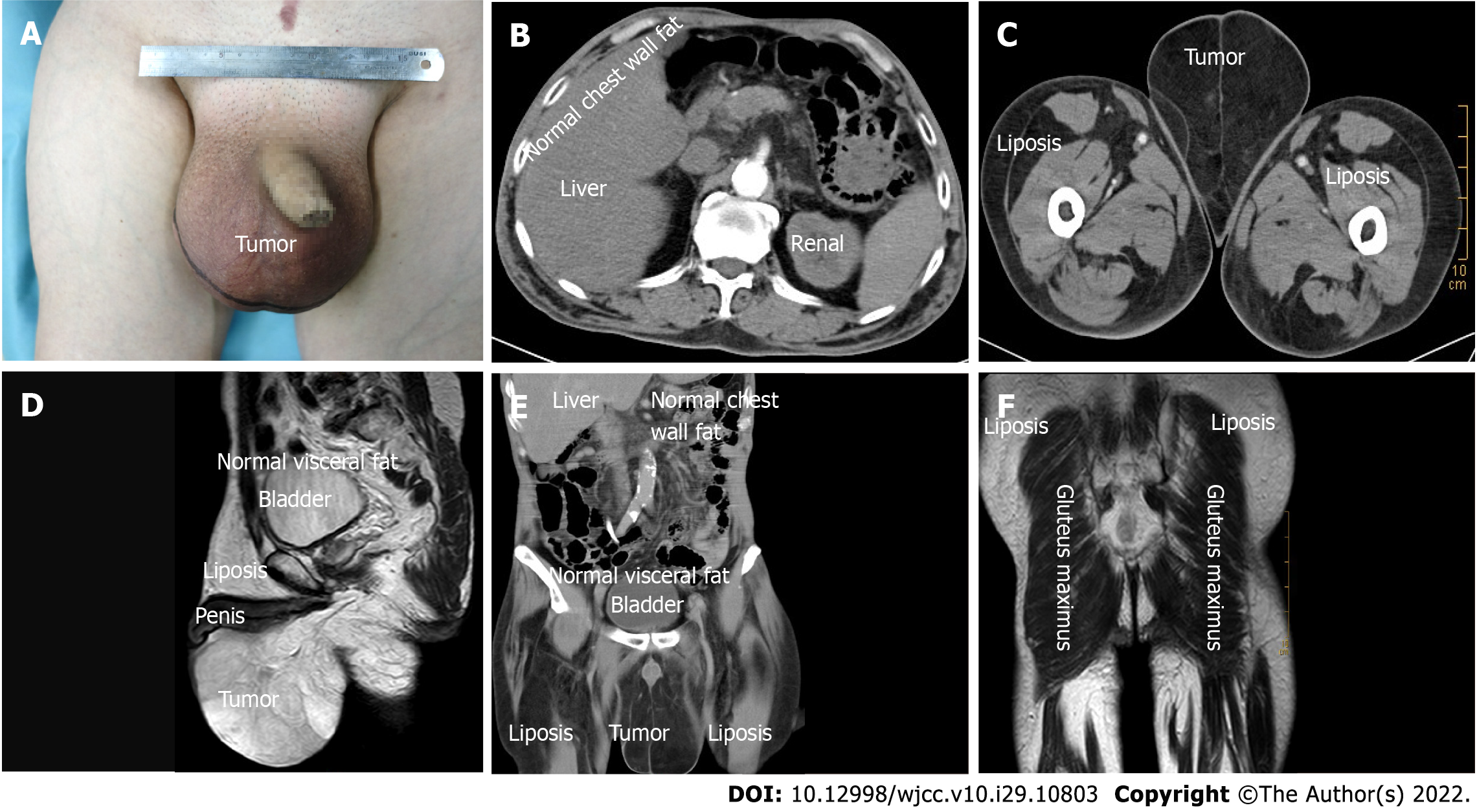 Giant bilateral scrotal lipoma with abnormal somatic fat distribution: A  case report