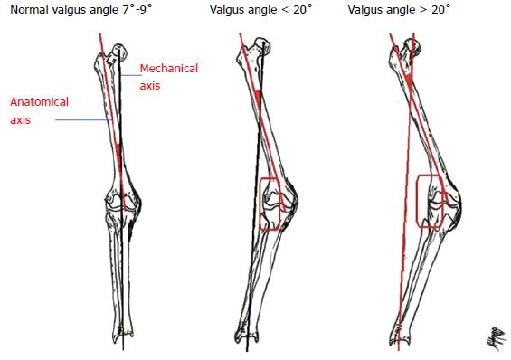 Knee Valgus Angle Valgus Knee Definition WFBJFJ Knee Valgus Angle Valgus Knee Definition WFBJFJ