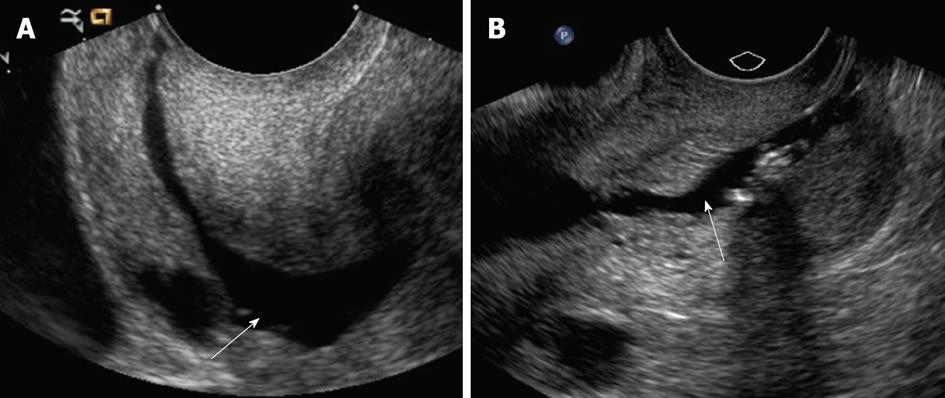 Sonohysterography Principles Technique And Role In Diagnosis Of Endometrial Pathology