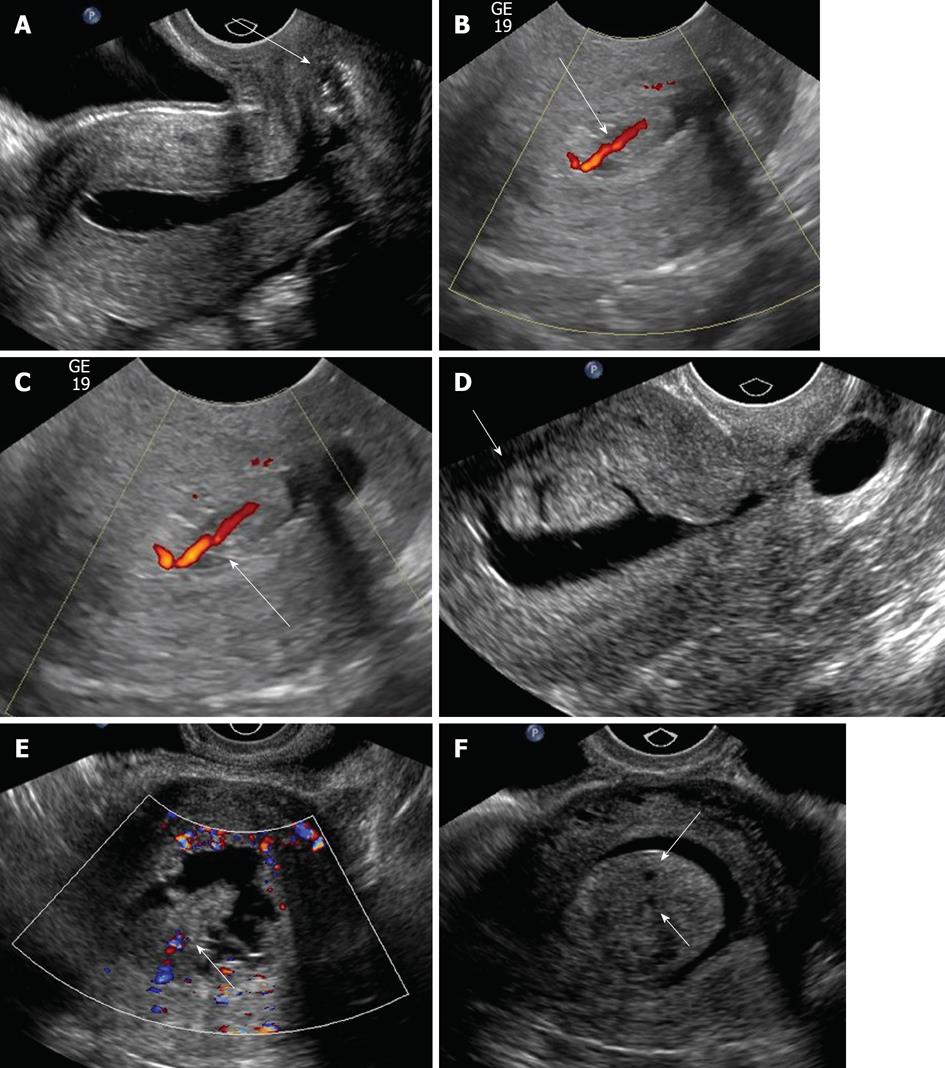 Sonohysterography Principles Technique And Role In Diagnosis Of Endometrial Pathology