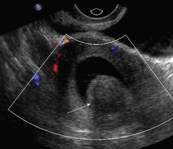 Sonohysterography Principles Technique And Role In Diagnosis Of Endometrial Pathology