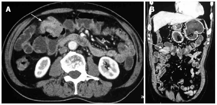 Ileo Ileal Intussusception Caused By Diffuse Large B Cell Lymphoma Of
