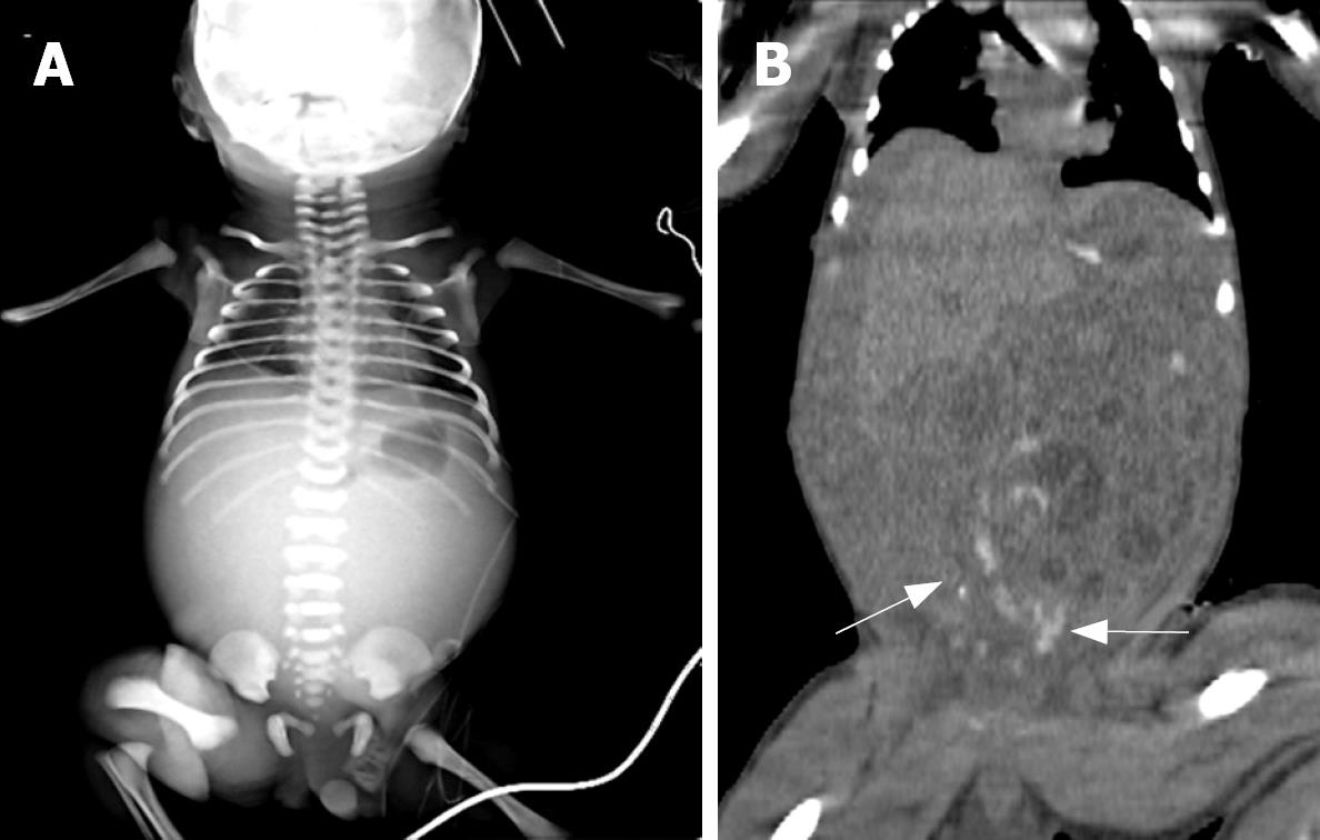 Intrauterine Midgut Volvulus Without Malrotation Diagnosis From
