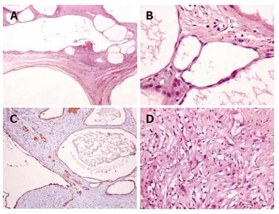 Benign Multicystic Peritoneal Mesothelioma A Case Report And Review Of The Literature