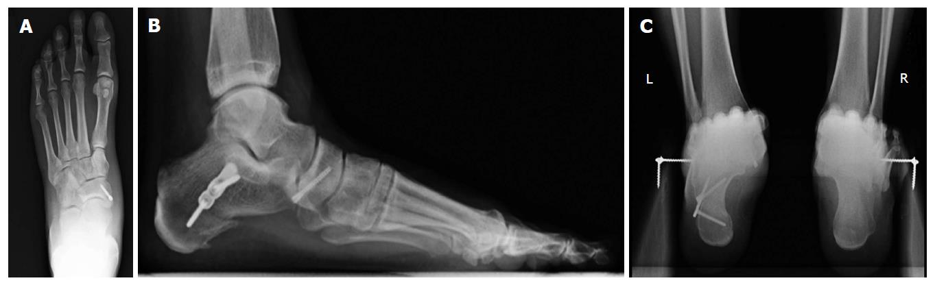 The Cotton Osteotomy in Flexible Flatfoot Correction