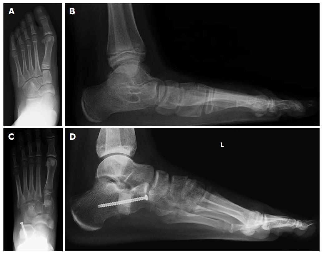 How to approach the pediatric flatfoot