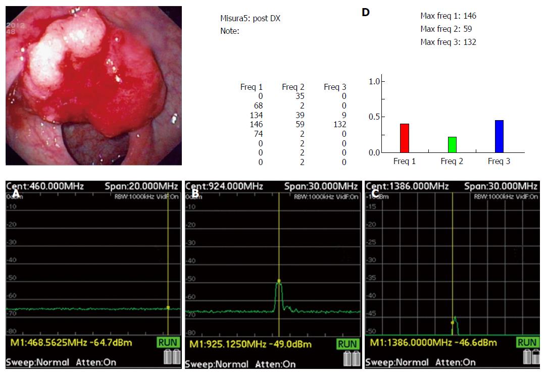 Tissue resonance interaction accurately detects colon lesions: A  double-blind pilot study