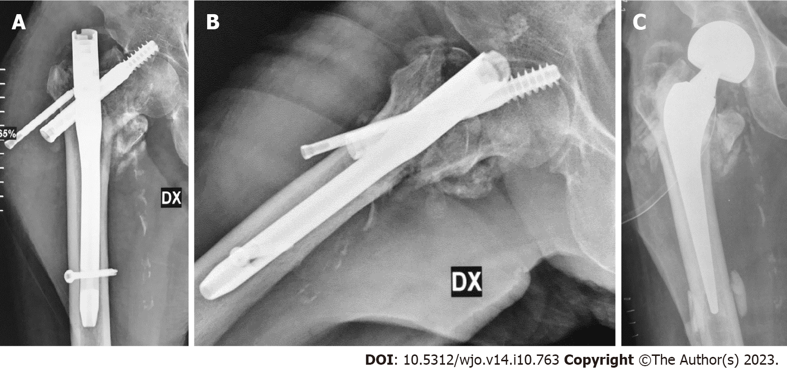 Cureus | Secondary Subtrochanteric Fracture After Atypical Femoral Shaft  Fracture Treated With Intramedullary Nail | Article
