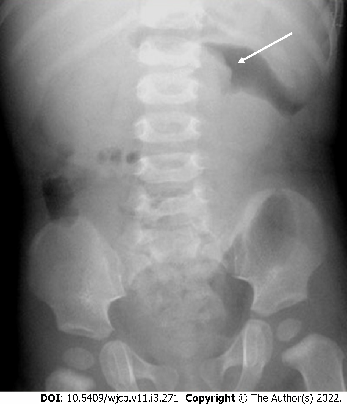 intussusception claw sign