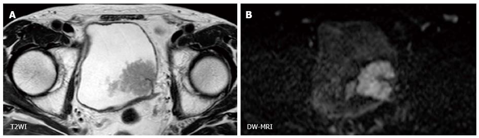 Diffusion Weighted Magnetic Resonance Imaging In Management Of Bladder Cancer Particularly With Multimodal Bladder Sparing Strategy