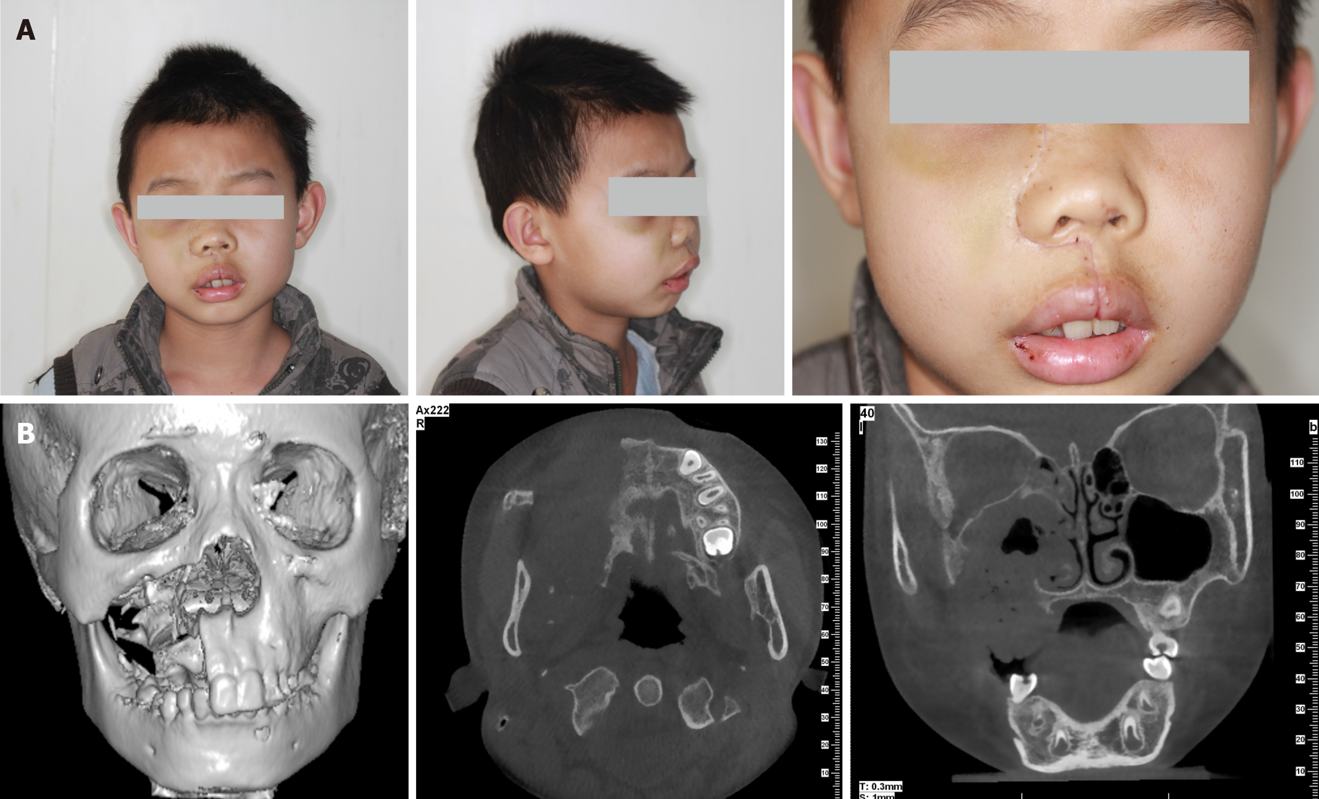Intraosseous Venous Malformation Of The Maxilla After Enucleation Of A ...