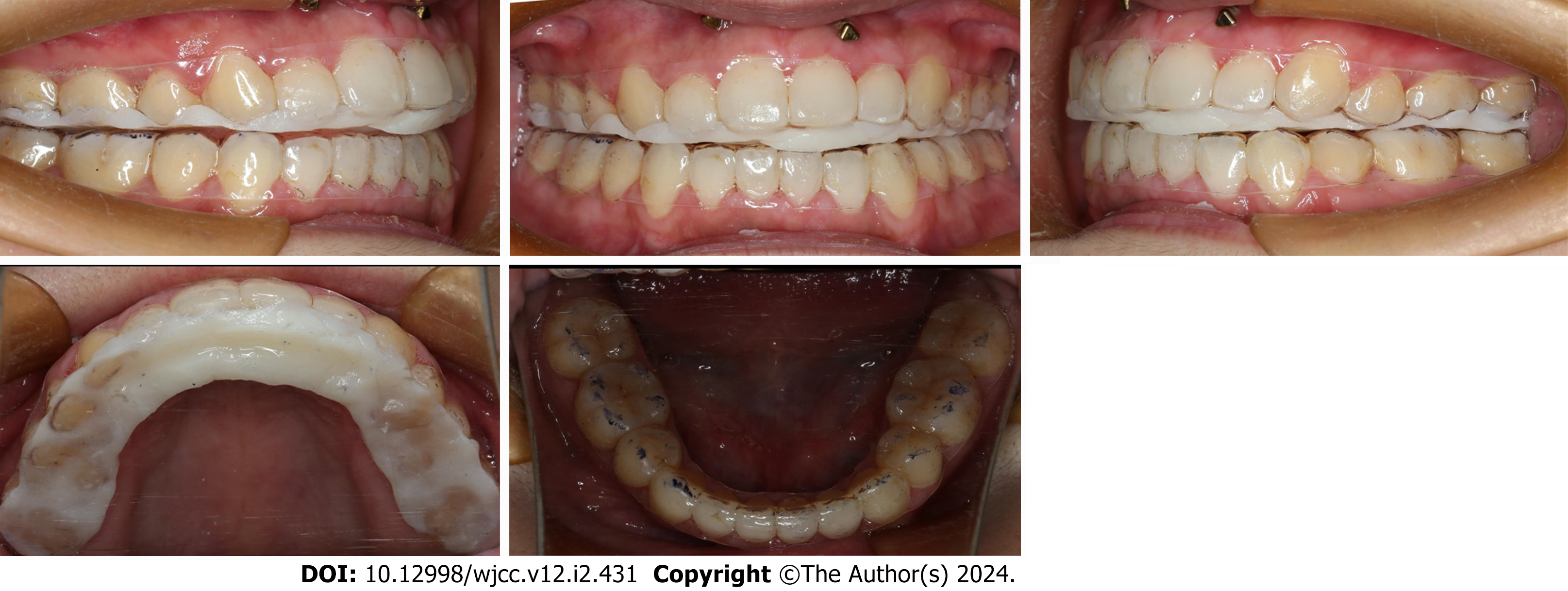 What does a reverse curve wire do for braces? 1 Month Check Up - Tooth Time  Family Dentistry 