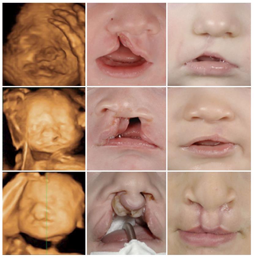 cleft lip 2d ultrasound