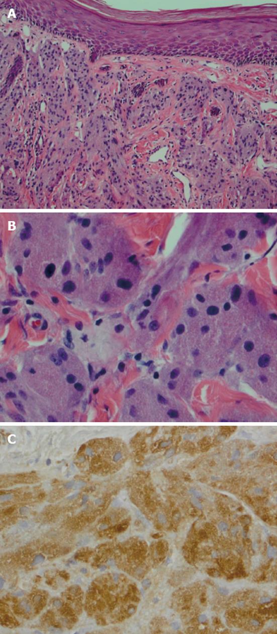 A Rarely Seen Granular Cell Tumor of the Mons Pubis—a Case Report