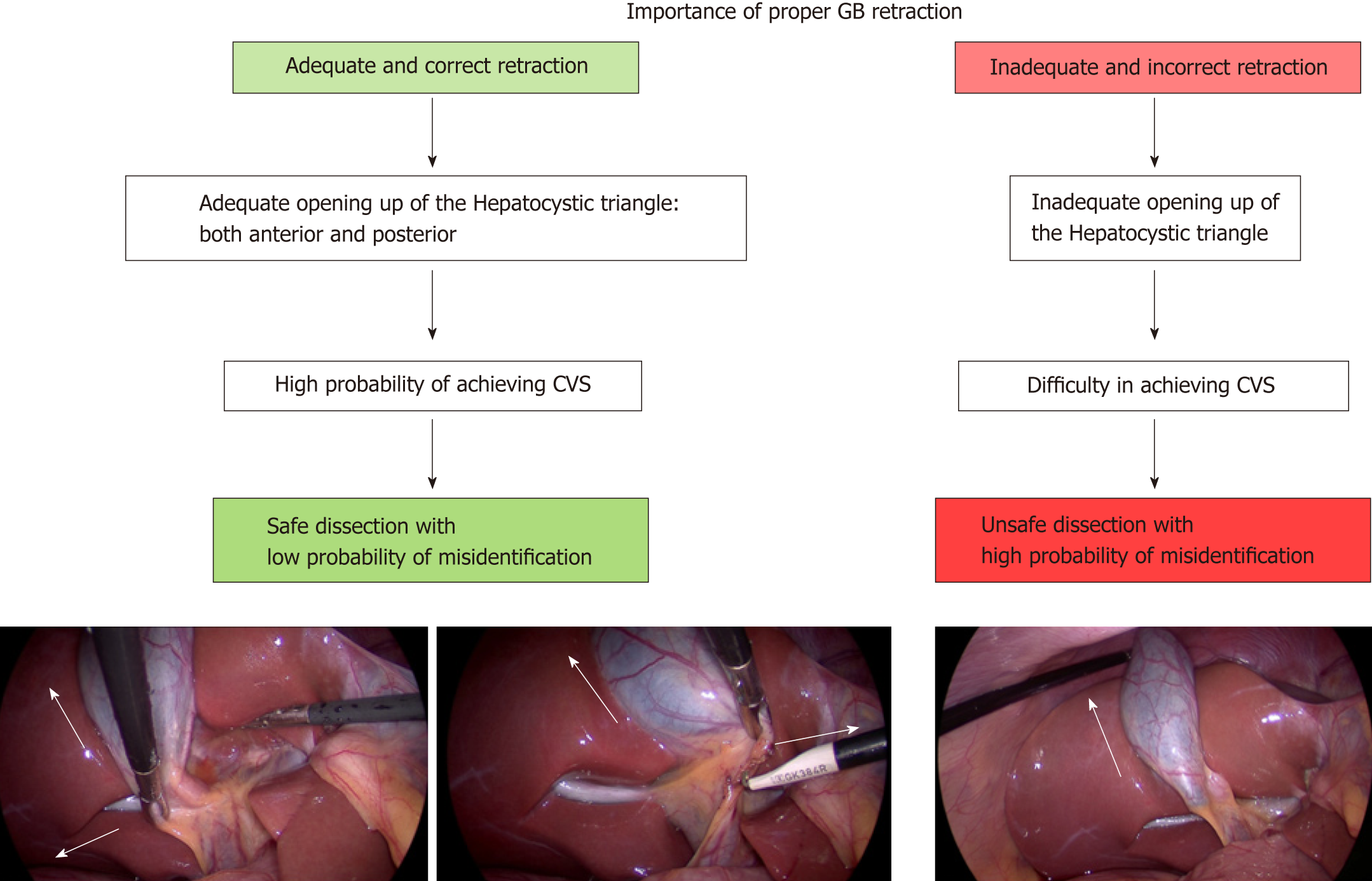 Cholecystectomy Anatomy