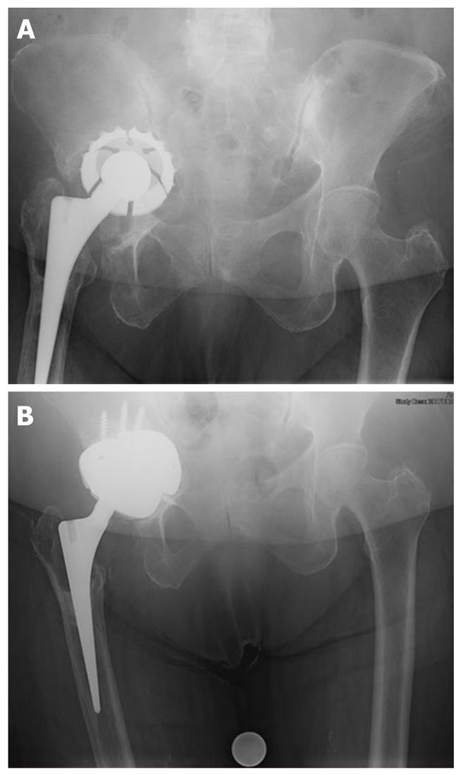 Reconstruction Options For Acetabular Revision