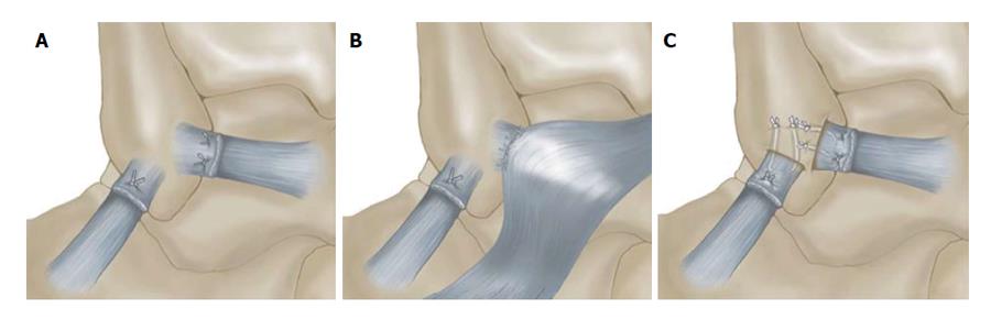 Treating Chronic Ankle Instability