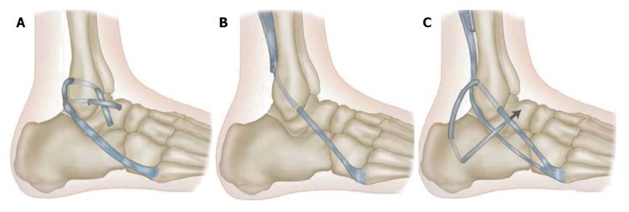 Ankle Instability – Diagnosis and Management of Acute and Chronic