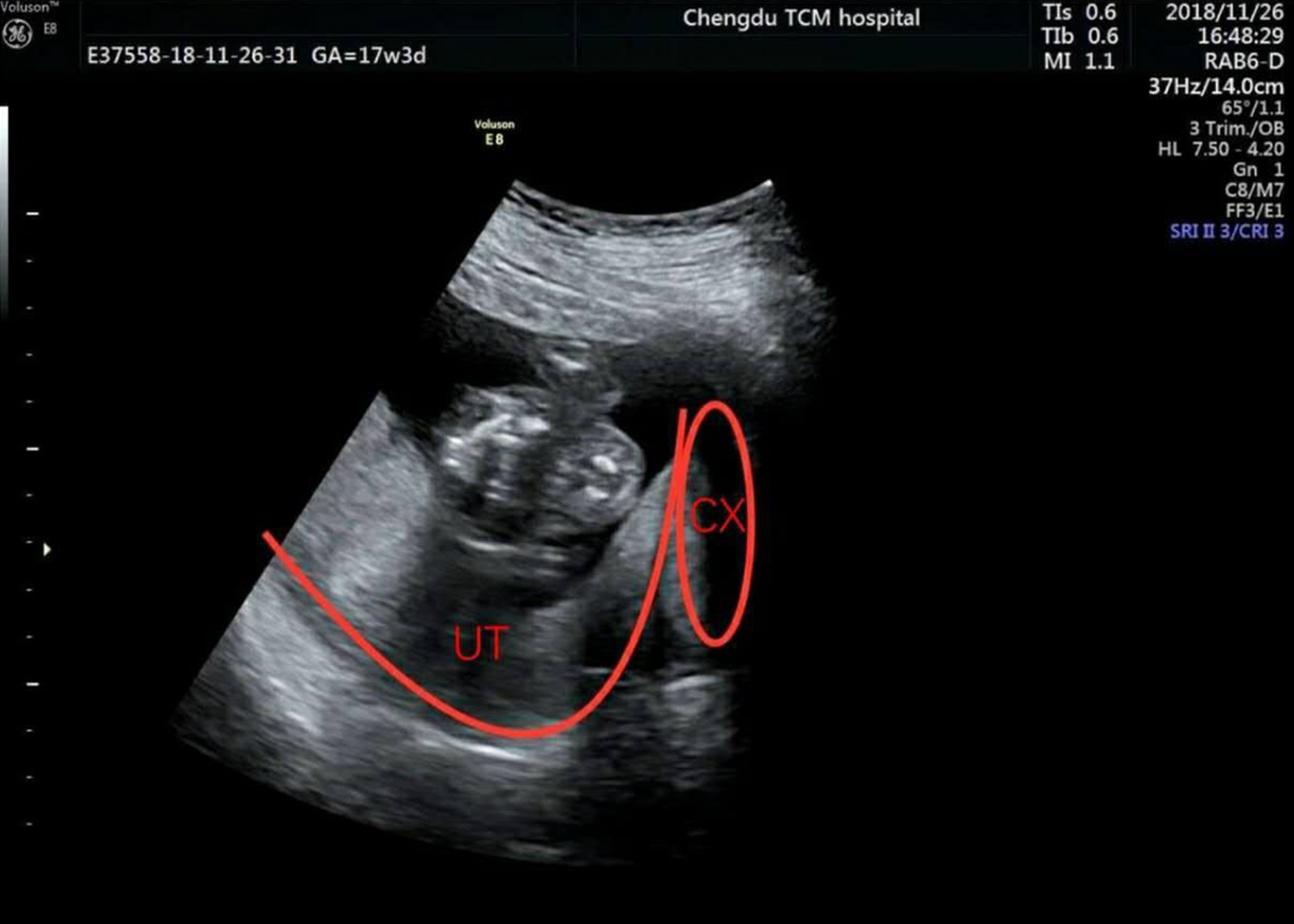 Acute urinary retention in the first and second-trimester of pregnancy:  Three case reports