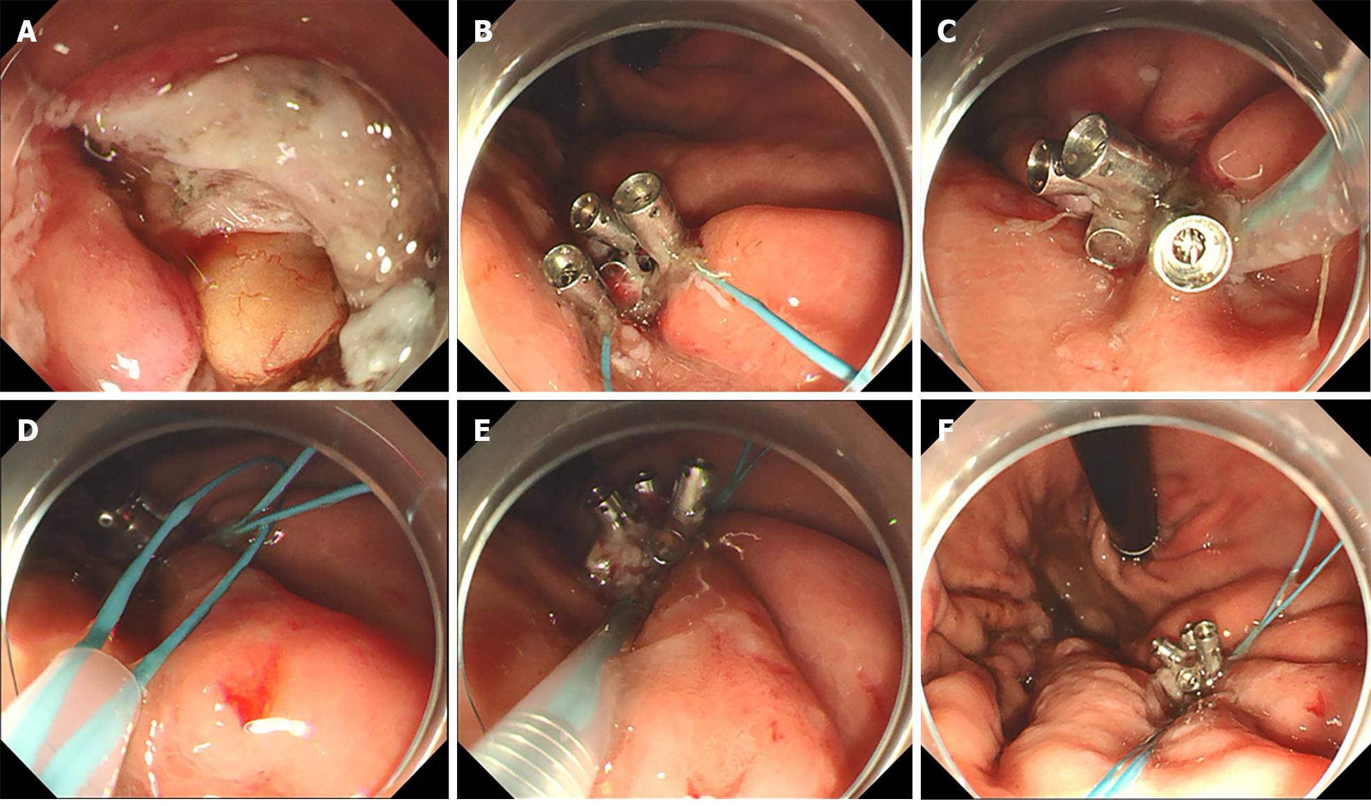 A simplified laparoscopic-assisted gastrostomy technique: a single center  experience | Annals of Pediatric Surgery | Full Text