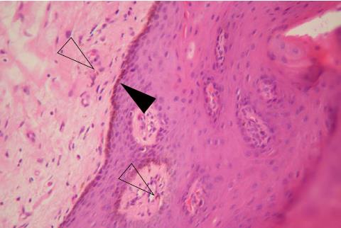 Mystery behind labial and oral melanotic macules: Clinical, dermoscopic and  pathological aspects of Laugier-Hunziker syndrome