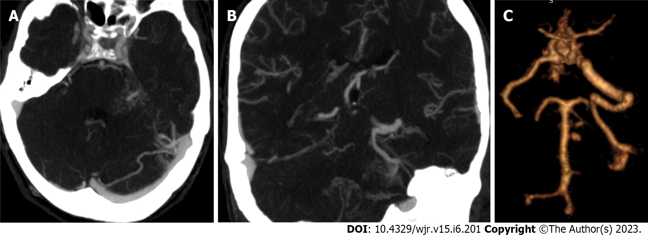 Imaging Evaluation of SAH and Aneurysm