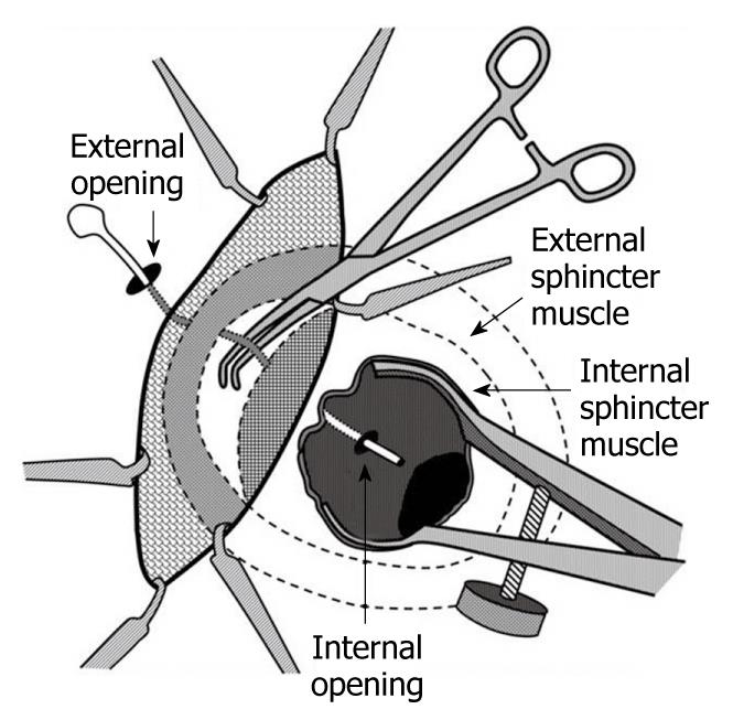 Current Management Of Cryptoglandular Fistula in ano