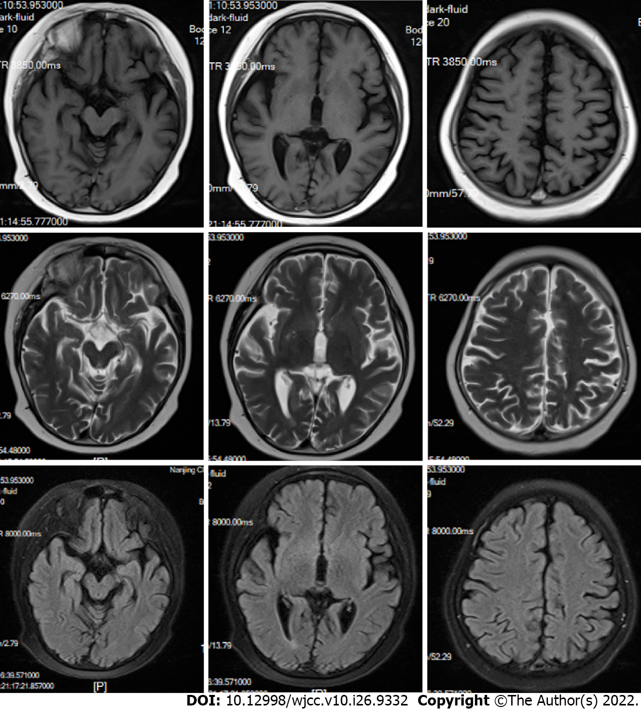 Rubinstein-Taybi syndrome 2 with cerebellar abnormality and neural