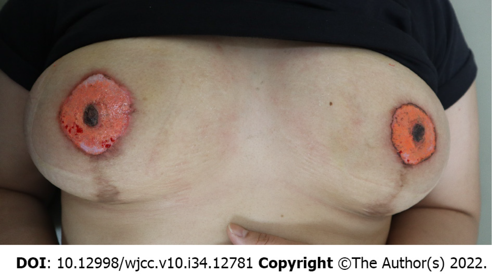 Complication after nipple-areolar complex tattooing performed by a non-medical person: A case report