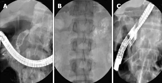 chronic pancreatitis ercp