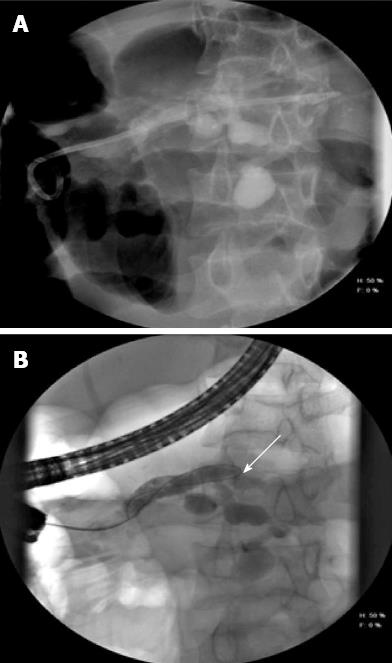 chronic pancreatitis ercp