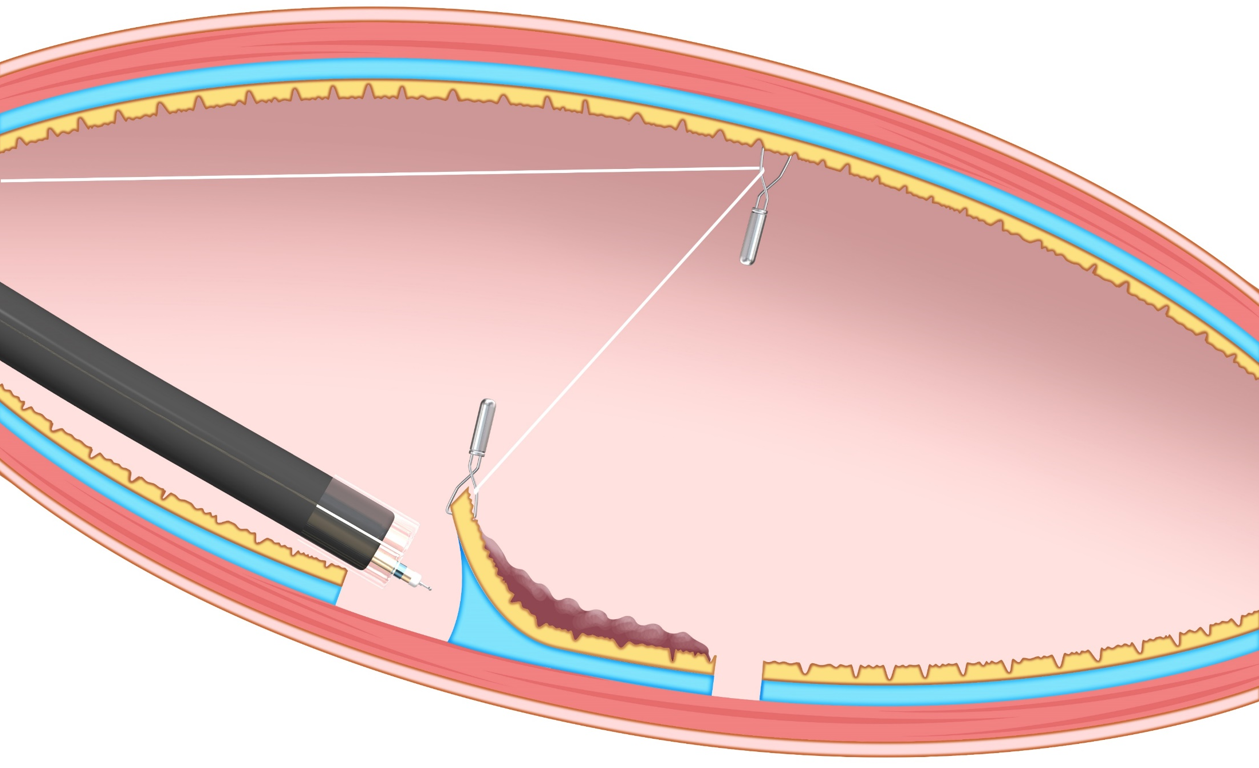 Deviceassisted traction methods in colorectal endoscopic submucosal