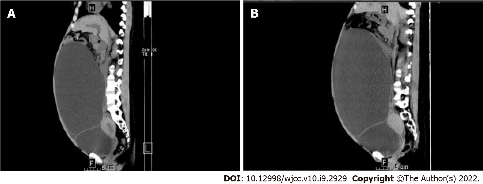 Turner syndrome with primary myelofibrosis, cirrhosis and ovarian