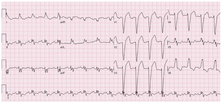 The ST segment: physiology, normal appearance, ST depression & ST elevation  –