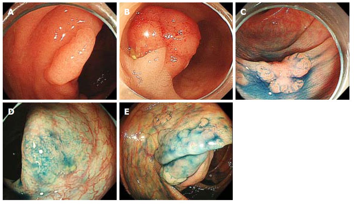 Sessile Serrated Polyps And Colon Cancer Prevention Cancerwalls