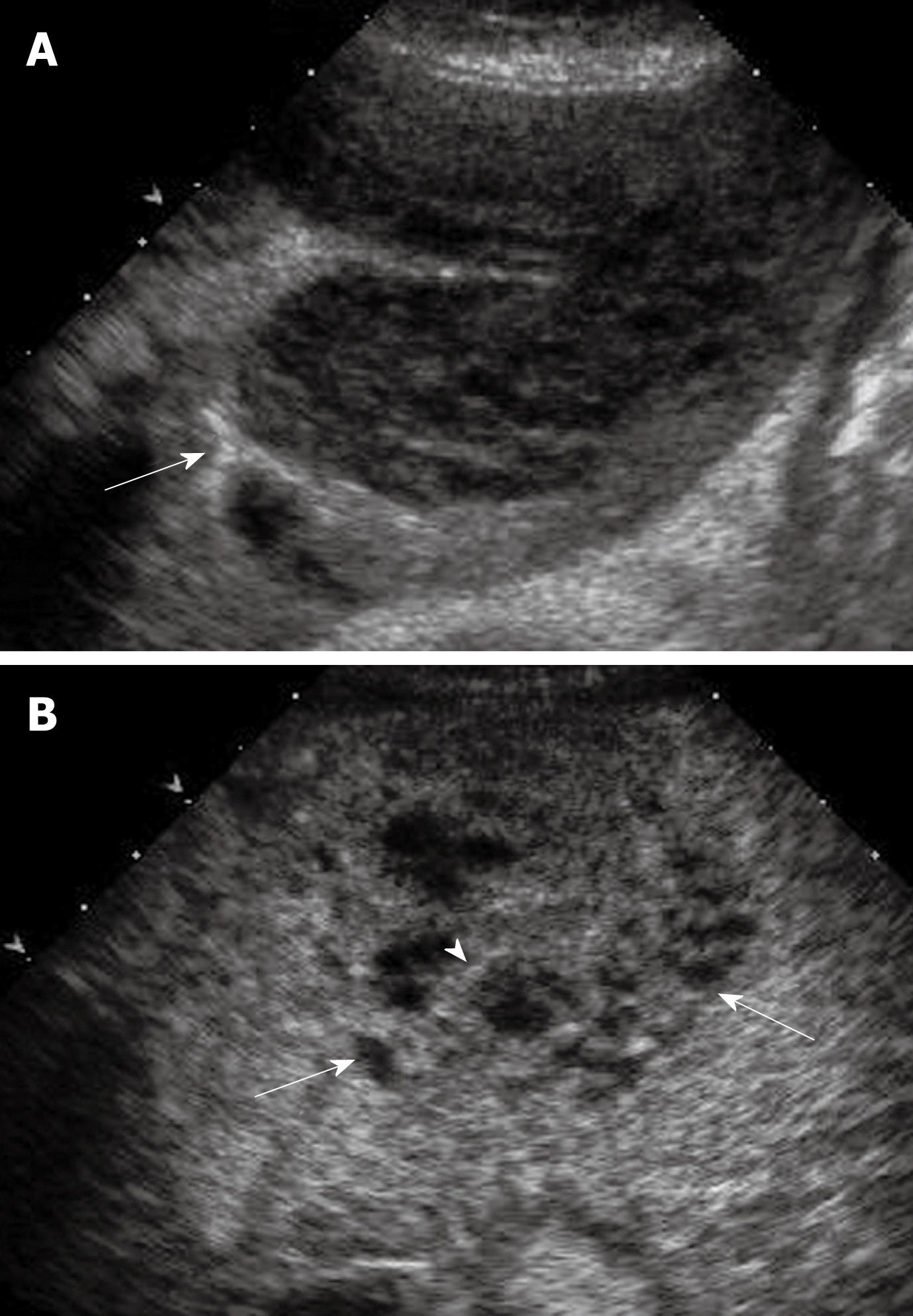 Lui Sprong bestellen Detection Of Focal Liver Lesions In Cirrhotic Liver Using Contrast-Enhanced  Ultrasound