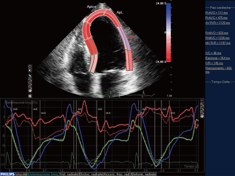 Speckle-Tracking Echo for Assessment of Myocardial Strain: A Case