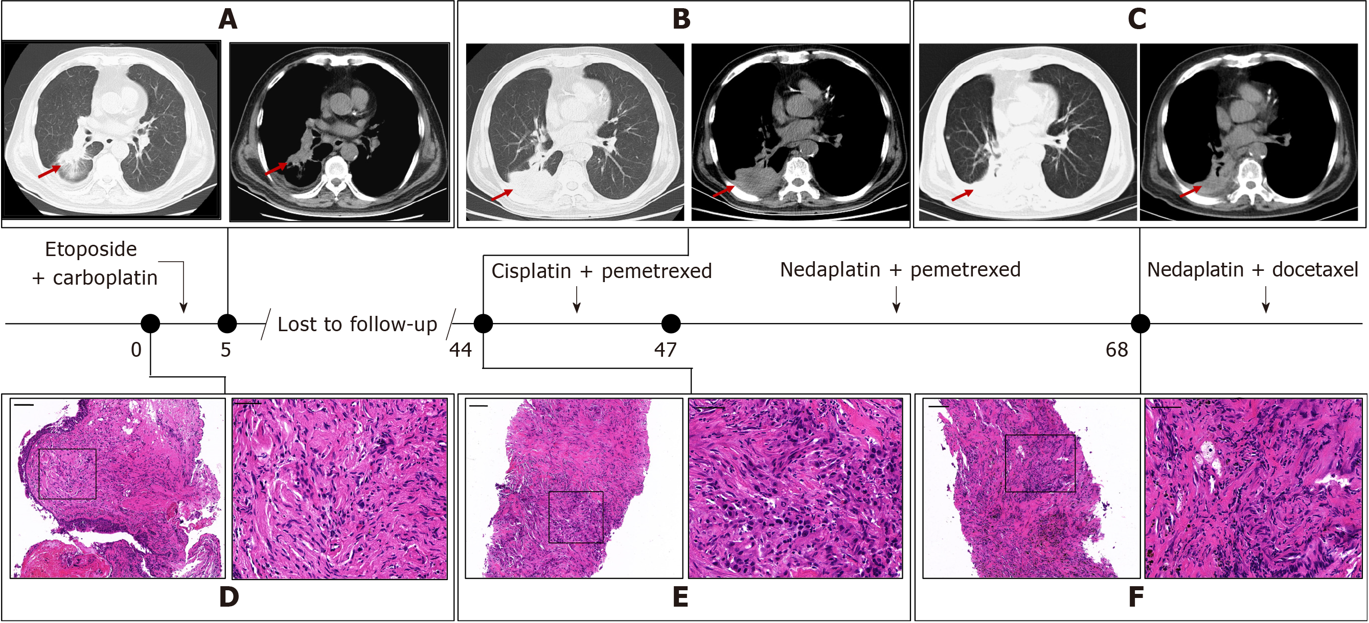 lung cancer histology