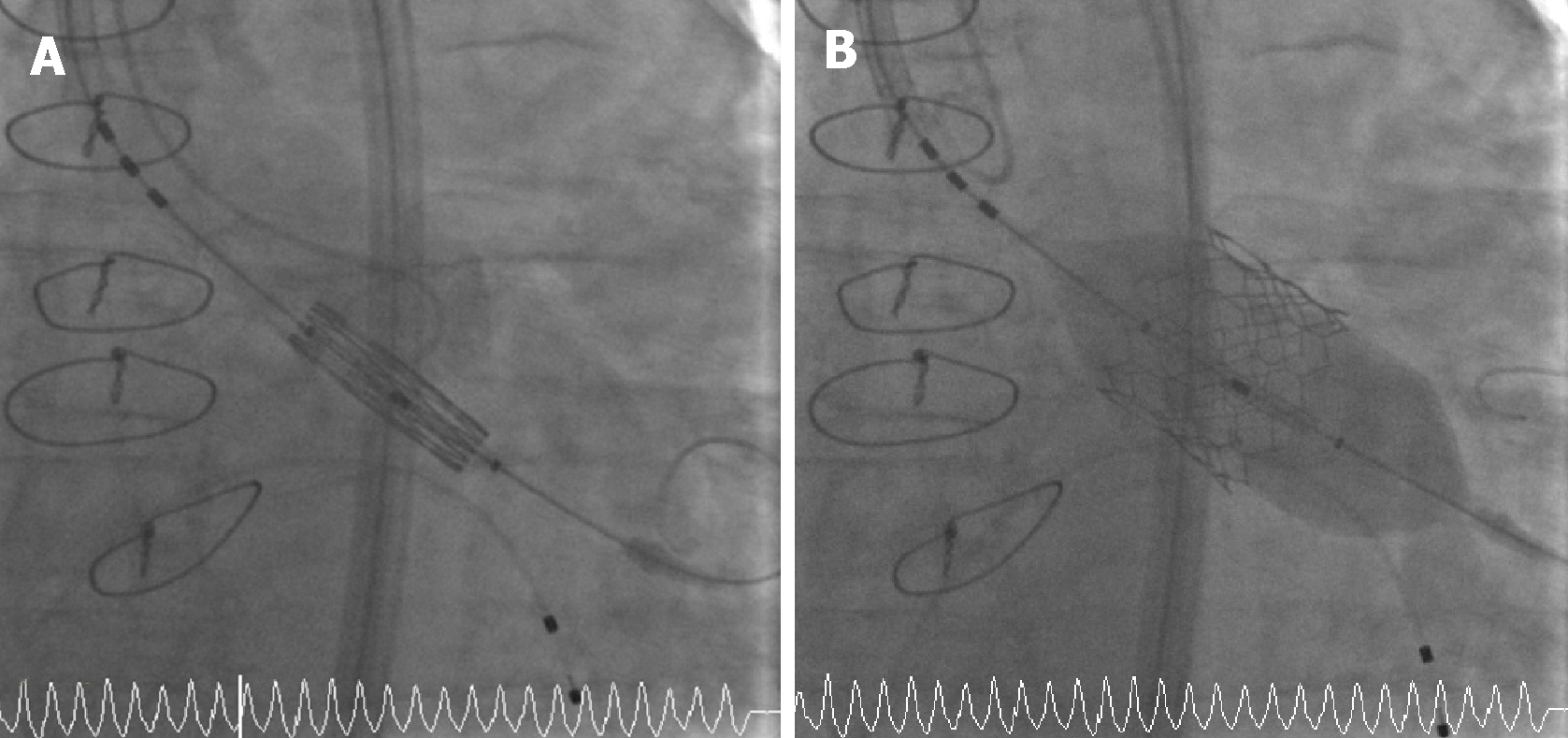Successful Minimal Approach Transcatheter Aortic Valve Replacement In