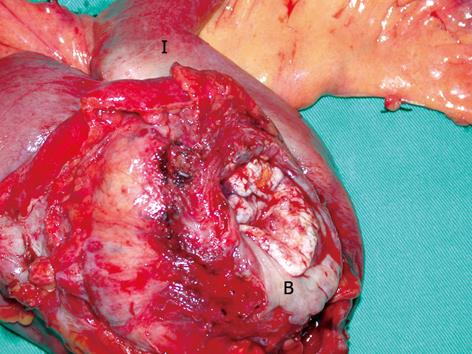 Bladder Fistula Repair