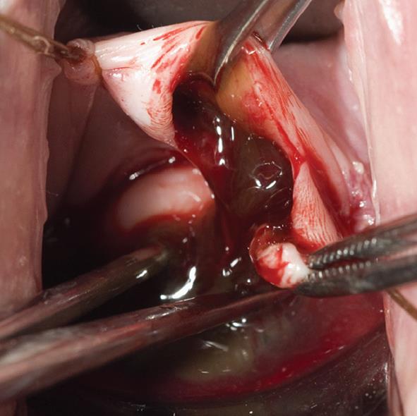 Intracystic hemorrhage in a non-endometriotic mullerian vaginal cyst