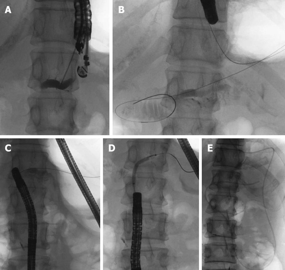 Pancreatic Duct Drainage Using Eus Guided Rendezvous Technique For Stenotic Pancreaticojejunostomy