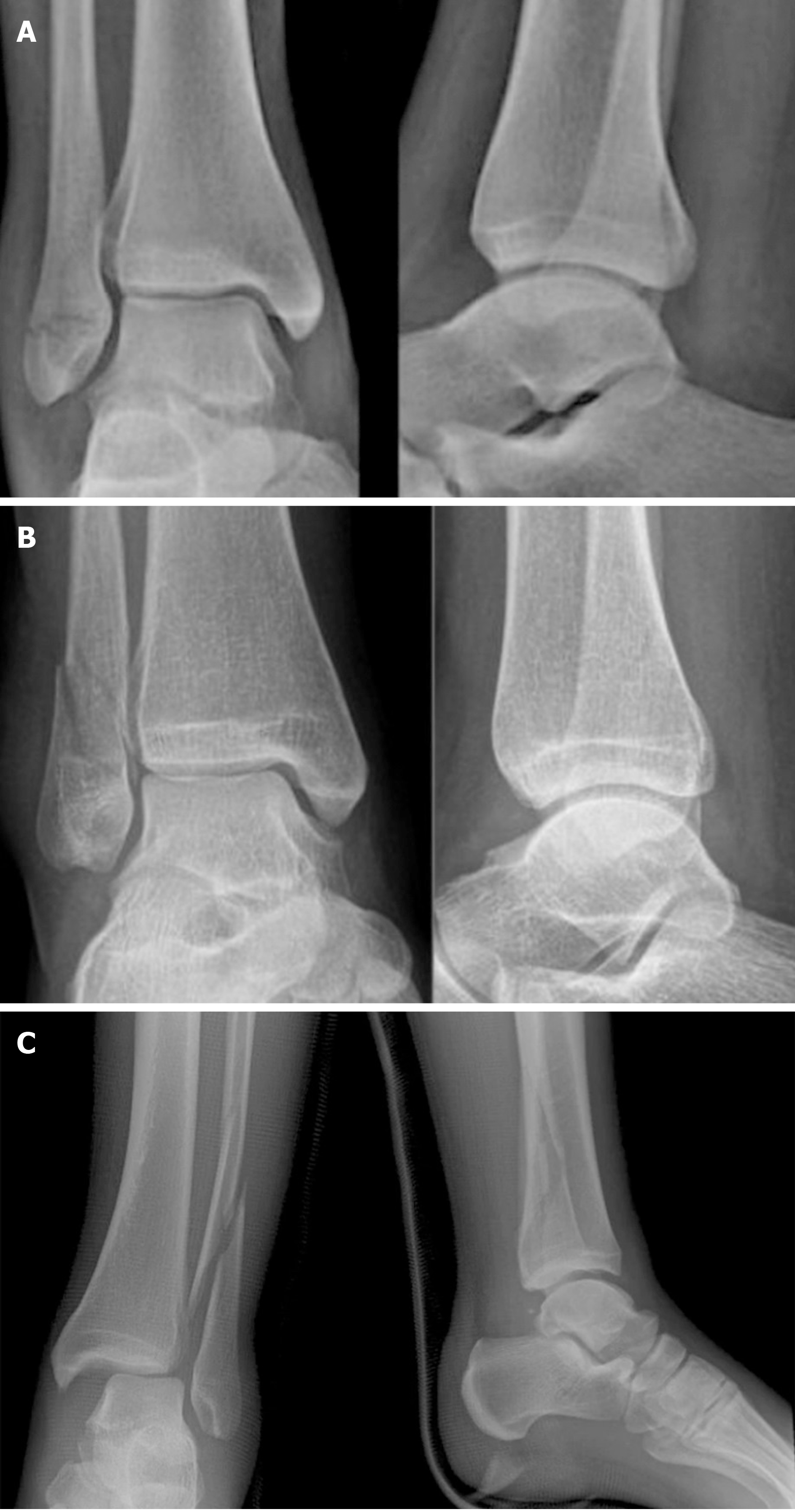 Acute syndesmotic injuries in ankle fractures: From diagnosis to treatment  and current concepts