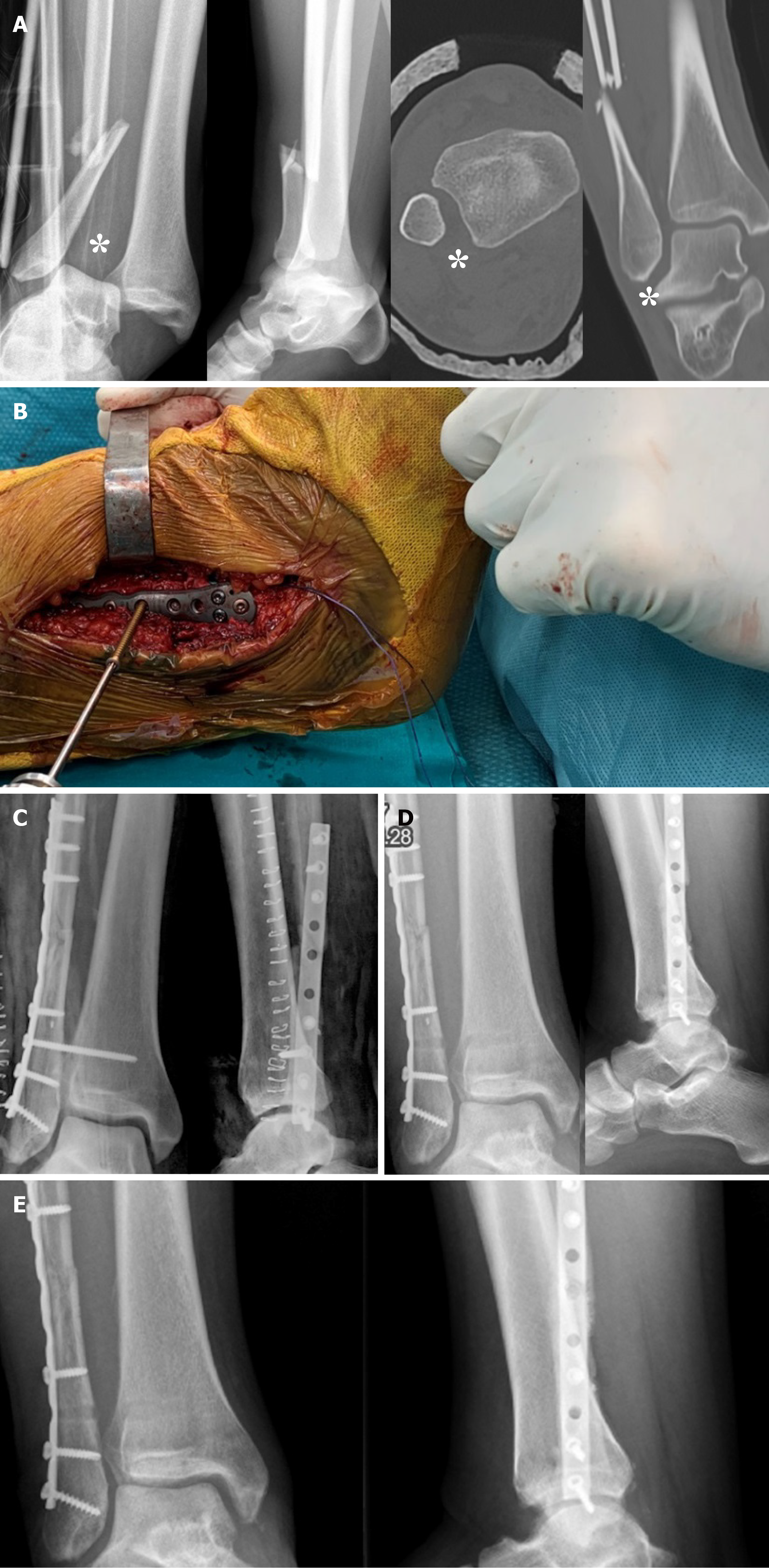 ankle syndesmosis fixation surgery in Washington D.C., Maryland