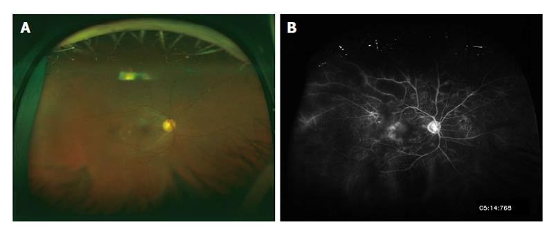 Diabetic retinopathy - ocular complications of diabetes mellitus