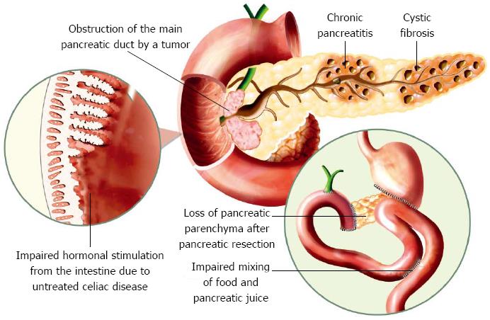 Ekzokrin Pankreas Yetmezliği Nedir?