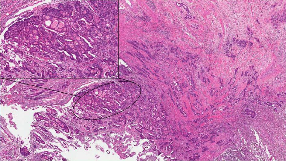 Ampulla Of Vater Carcinoma Molecular Landscape And Clinical Implications