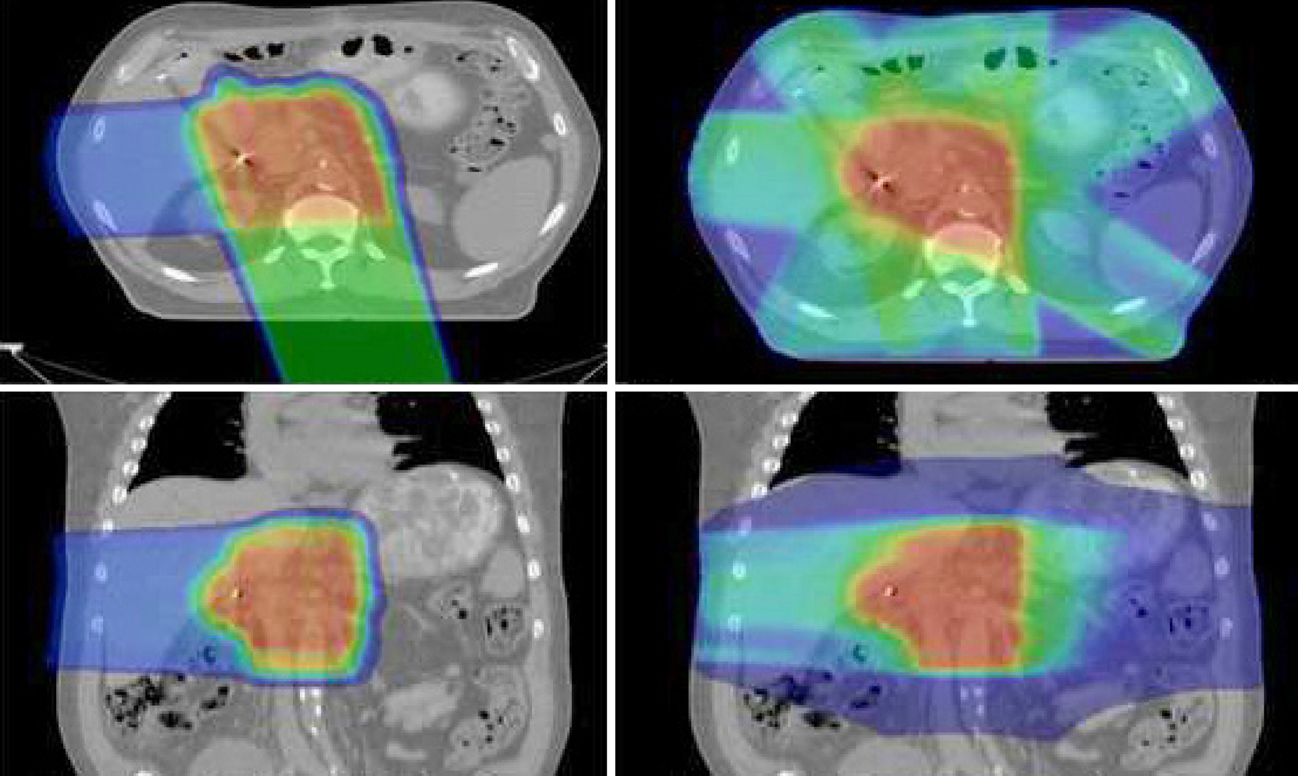 New Guidelines for Radiation Therapy in Pancreatic Cancer
