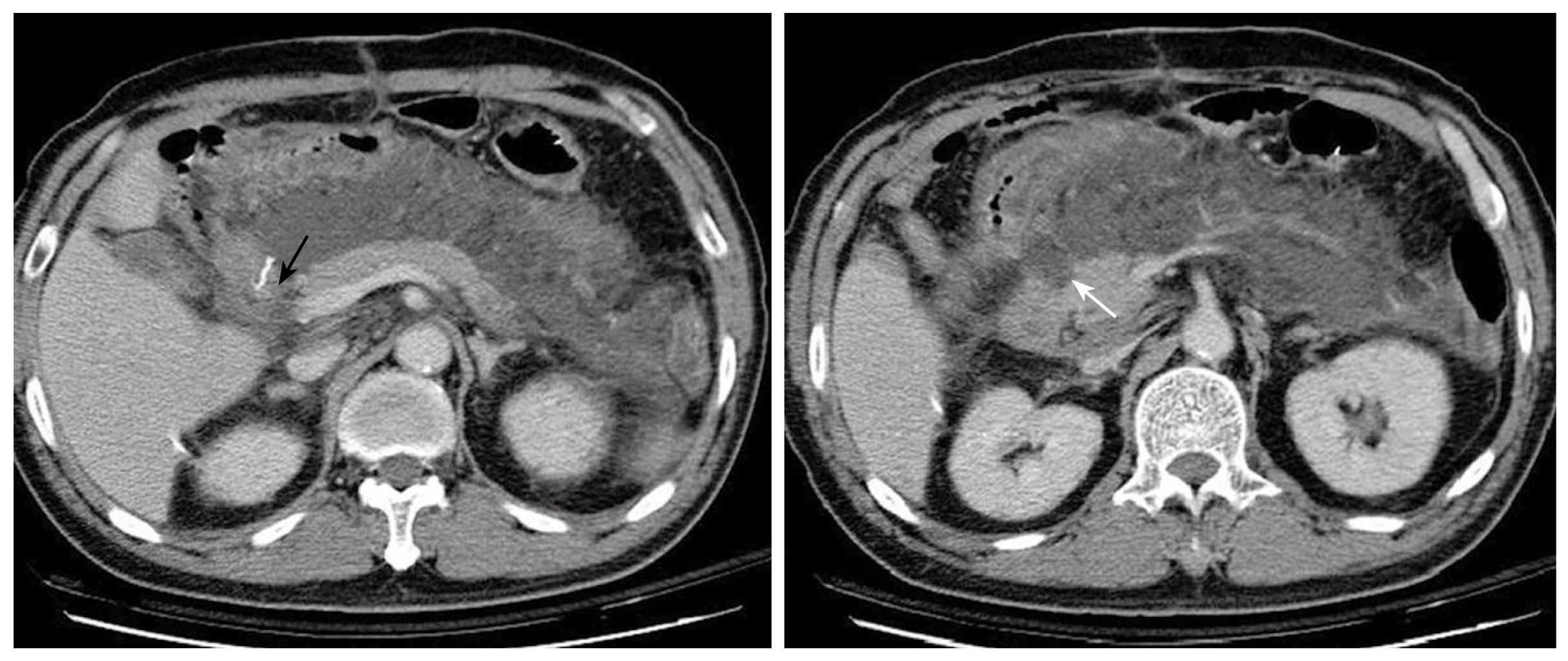 Post-gastrectomy acute pancreatitis in a patient with gastric carcinoma